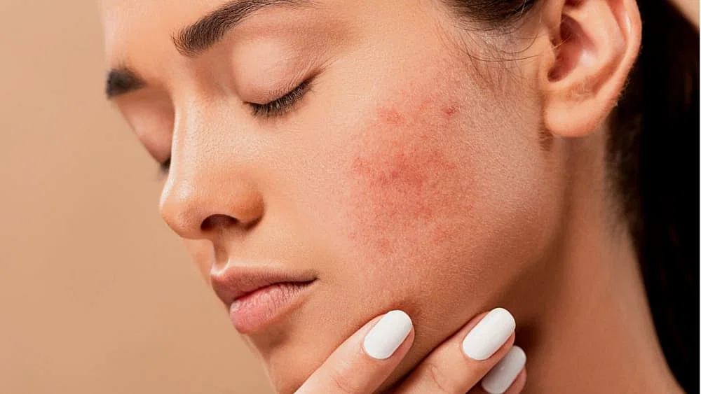 What Is Hormonal Acne?