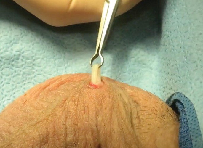 No-Scalpel Vasectomy