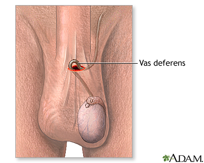 Understanding the Types of Vasectomy Procedures