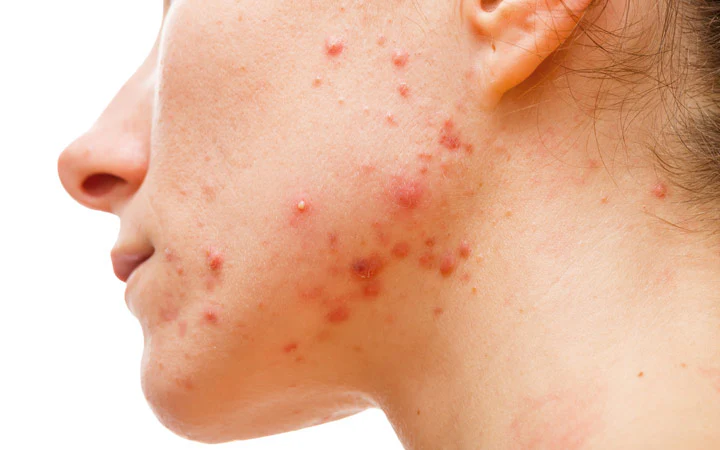 What Makes Hormonal Acne Different?