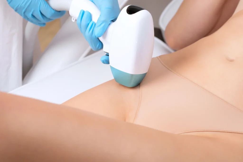 using laser for vaginal bleaching