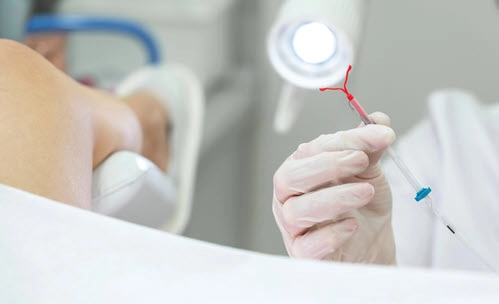 doctor removing a failed IUD
