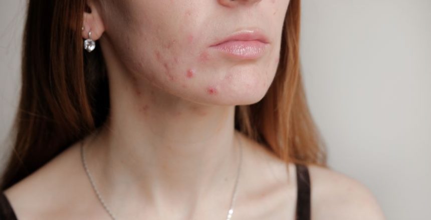 woman with acne on her face