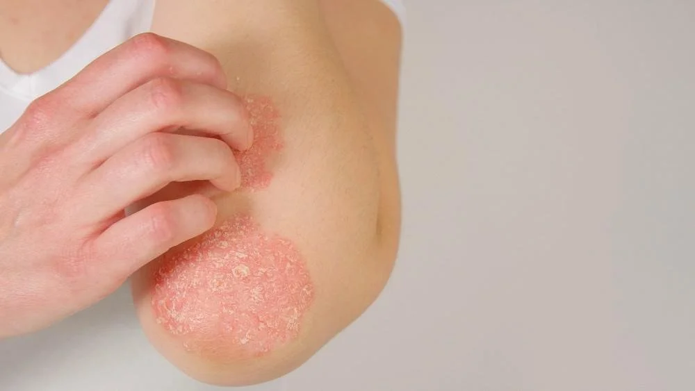 linchen sclerosus