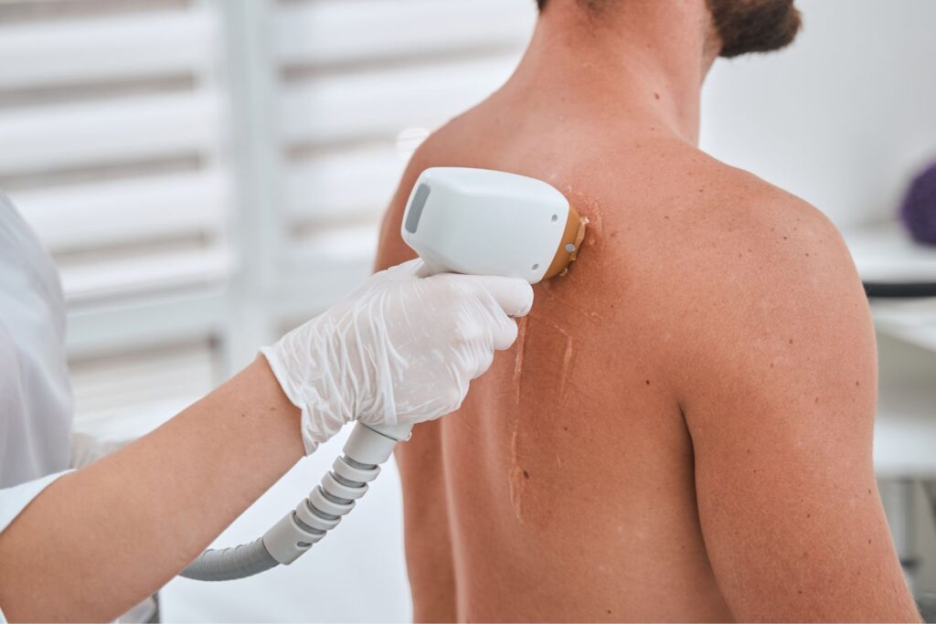 Laser Hair Removal