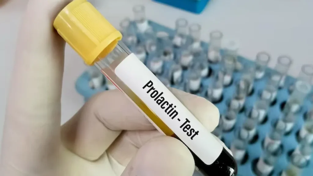 Treatment Options for High Prolactin in Men