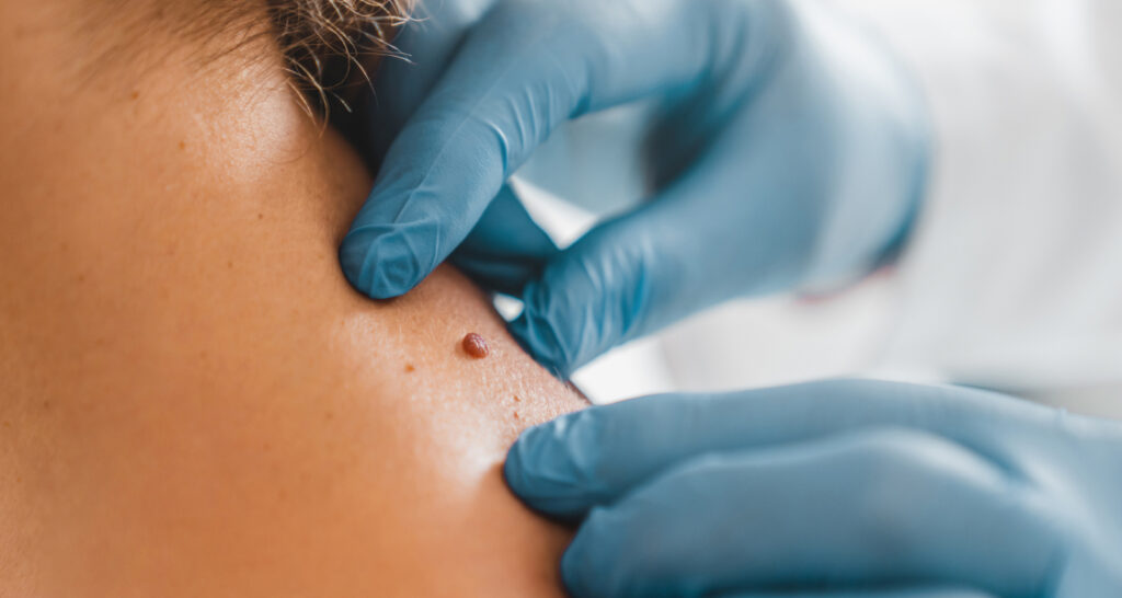 Electrosurgery (Electrocautery or Electrodessication)