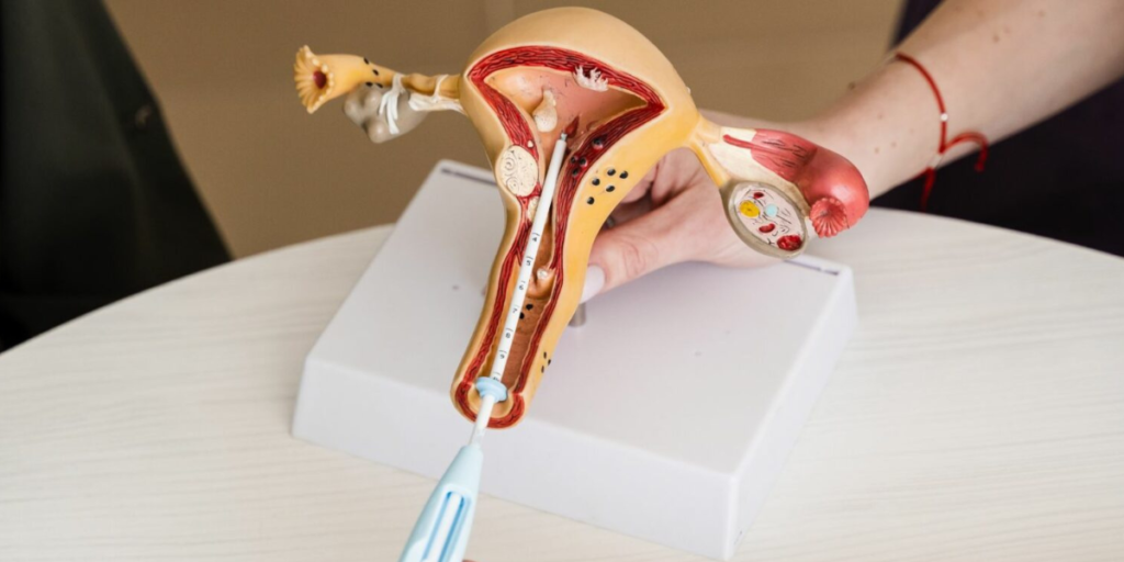 What Is Intrauterine Insemination (IUI)?