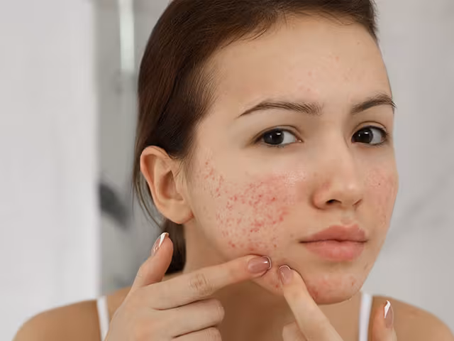 What Is PCOS Acne?