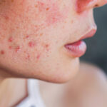 Why Does PCOS Acne Get Worse During Ovulation?