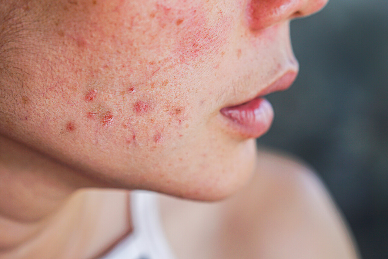 Why Does PCOS Acne Get Worse During Ovulation?