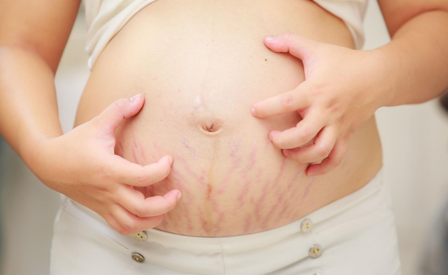 Itchy Belly During Pregnancy: Stretch Marks or PUPPP?