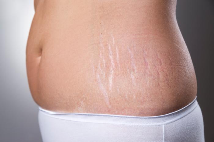 Why Can Stretch Marks Appear Without Weight Gain?
