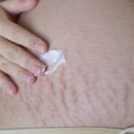 Why Are My Stretch Marks Purple?