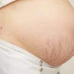 Why Are My Stretch Marks Red?