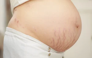 Why Are My Stretch Marks Red?