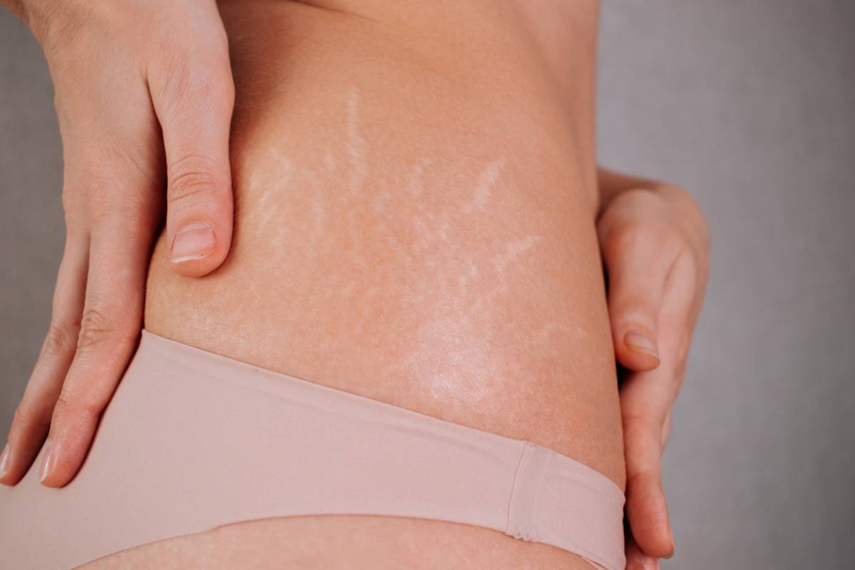 Why Can Stretch Marks Appear Without Weight Gain?